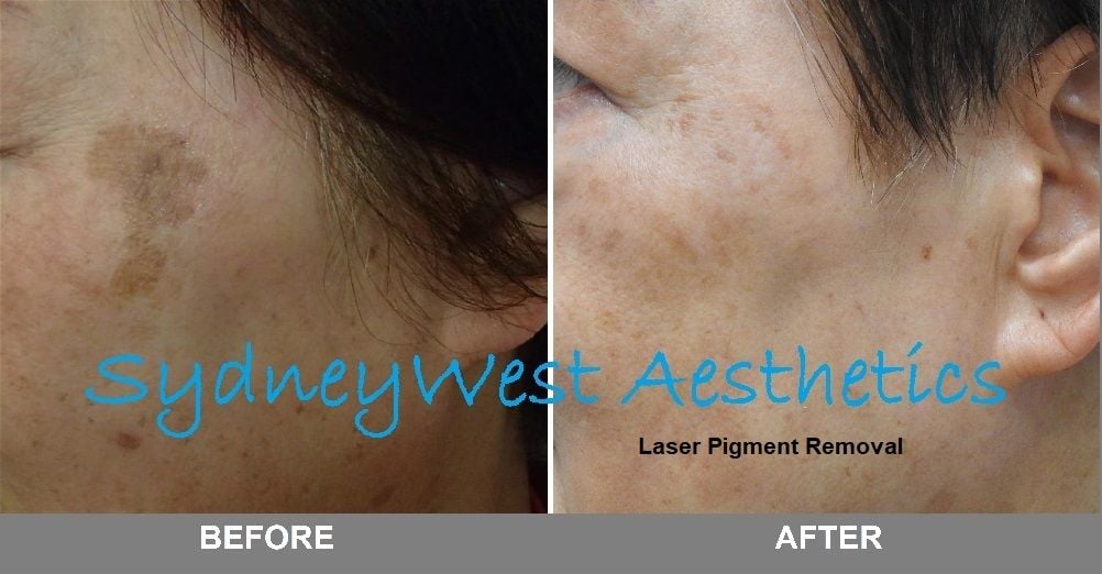 Pigmentation Image -5c8094af56928